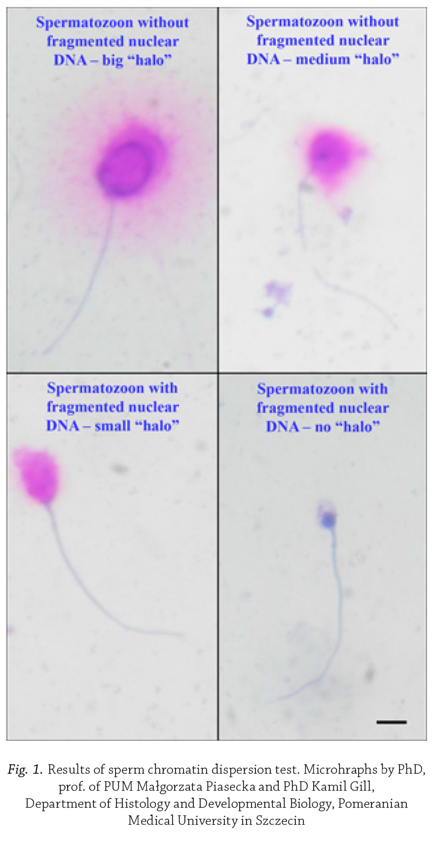 Fig. 1. Results of sperm chromatin 
    dispersion test.